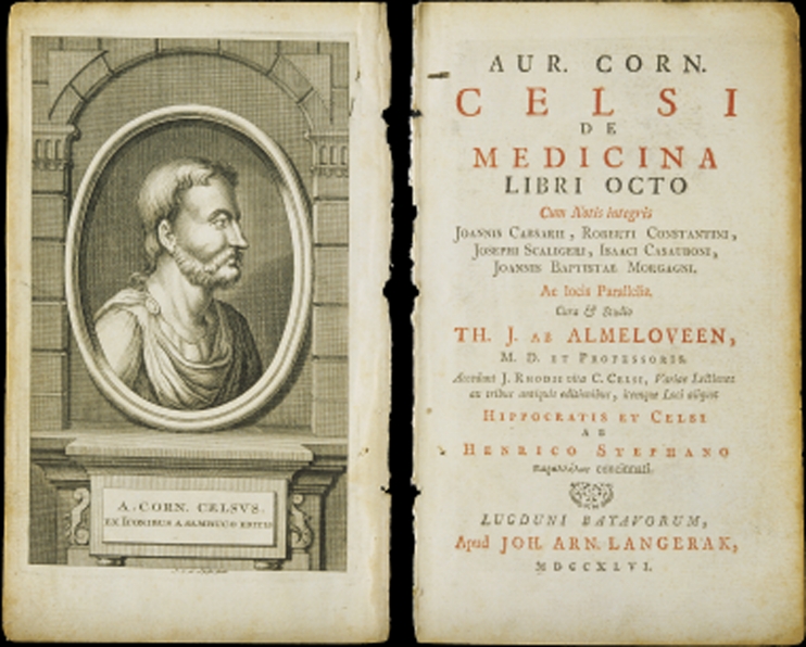 上图:塞尔苏斯(Aulus Cornelius Celsus,主前25-主后50年)编纂的百科全书《医术 De Medicina》。在这本书中提到希腊文称为elephantiasis graecorum的疾病,症状与现代的麻风病相似。但主前3-2世纪的希腊文七十士译本却把「大麻风 צָרַעַת」译为Λέπρα(lepra),意思是「使皮肤有鳞的病」。主后5世纪耶柔米(Jerome)在翻译拉丁文武加大译本时,也没有使用学名elephantiasis graecorum,而是使用lepra的音译,表明他并不认为lepra就是麻风病,而只是一种恶性皮肤病。从lepra转变来的英文leprosy,后来被用来称呼「麻风病 Hansen's Disease」。